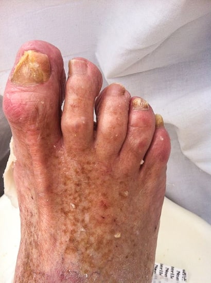 Mycose avant traitement