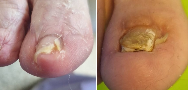 La phénolisation est la seule manière pour éviter les récidives.