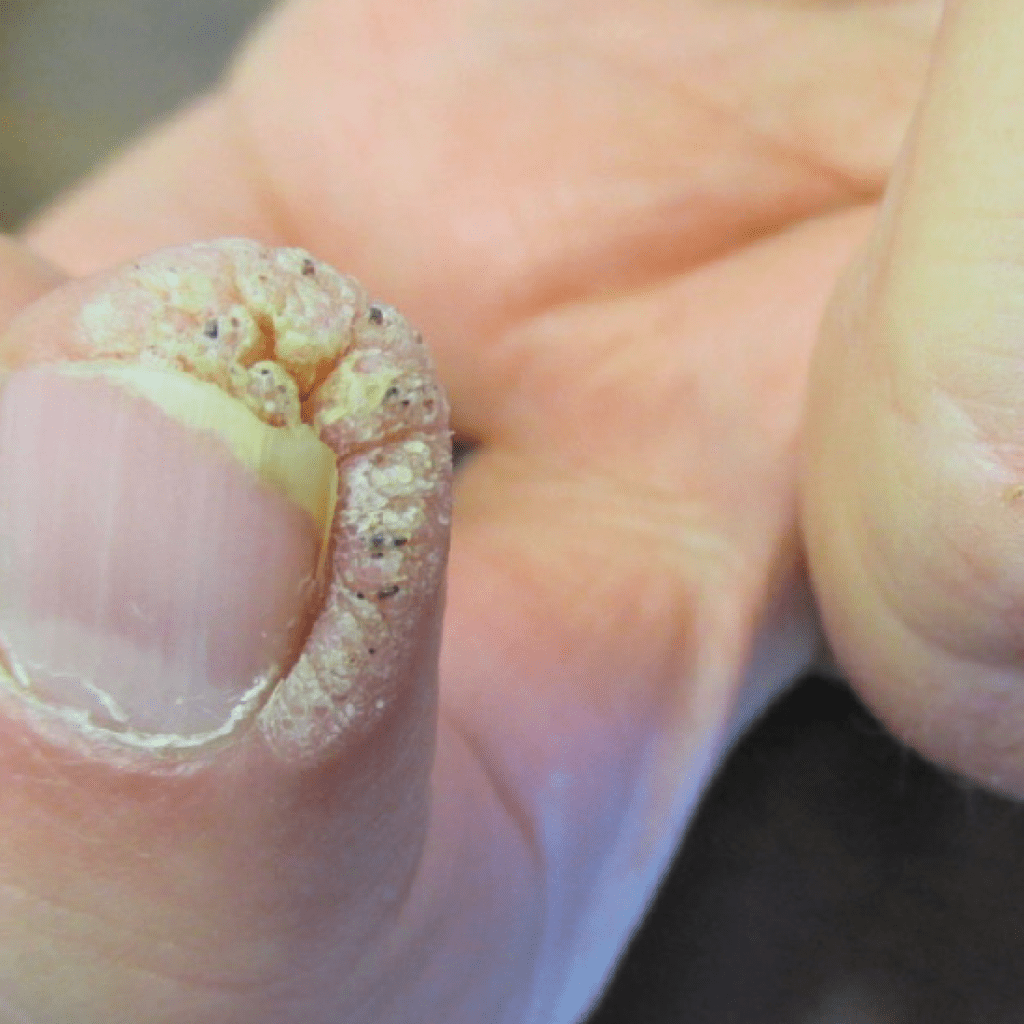 Il y a 3 types de verrues